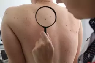 Hautkrebs-Screening