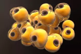 Wenn zu viel Fett zur Bedrohung wird: Ein Blick auf die Hypertriglyceridämie