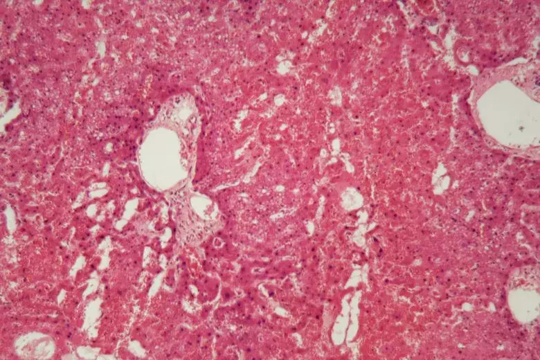 Amyloidose