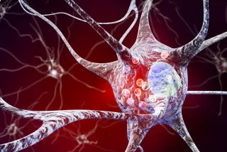 Mit Morbus Parkinson leben: Verständnis, Wegweiser und Behandlung