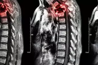 Von Diagnose bis Therapie: Ihr Wegweiser zu Wirbelsäulenmetastasen